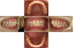 すきっぱ・八重歯/リンガル矯正の症例